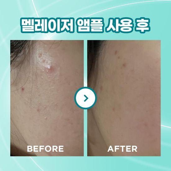 Athe Programming Ampoule 3-pack (Melrazer/Porecell/Acnesol)