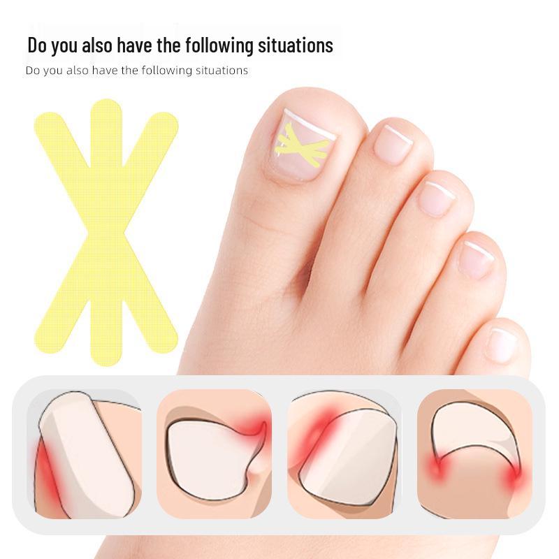 Star-Shaped Ingrown Toenail Correction Patch