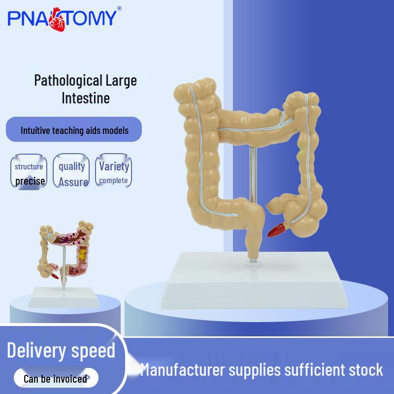 Colon Pathology Teaching Model: Large Intestine Lesions & Diseases 11*11*10cm
