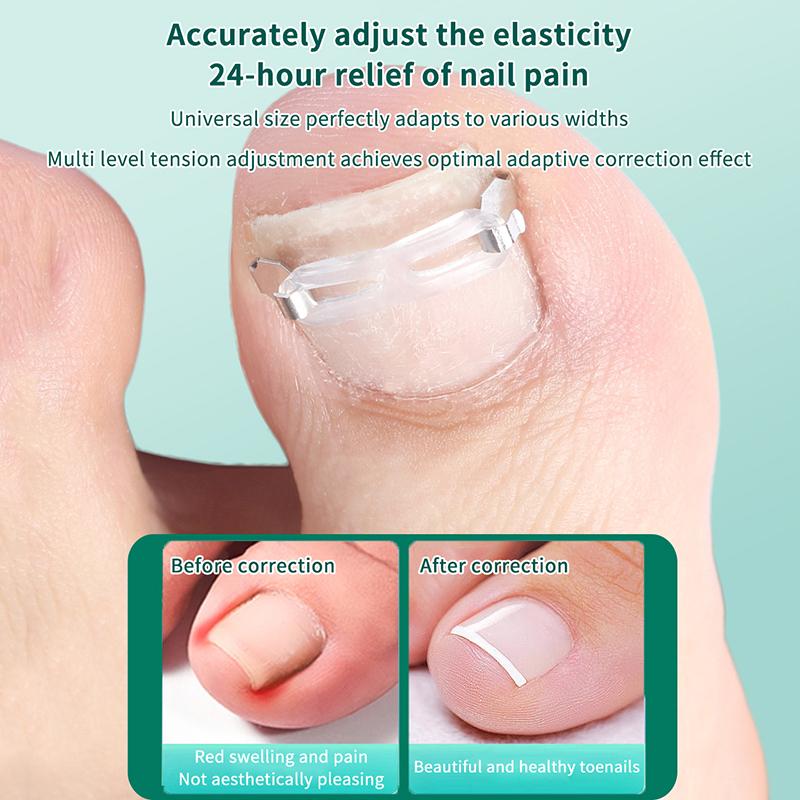 1/2 Set Ingrown Toenail Corrector Tools Pedicure Recover Embed Toenail Treatment Professional Foot Care Correction Tool
