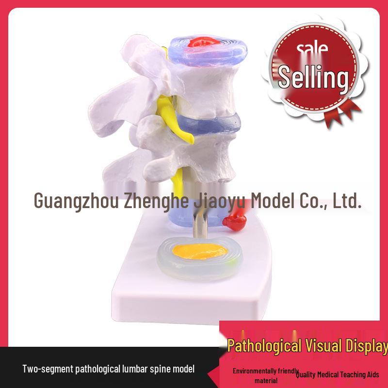 Lumbar Vertebrae Herniation Model for Medical Teaching