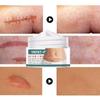 Deeply Permeate Cuticle Skin Care Acne Stretch Scar Cream