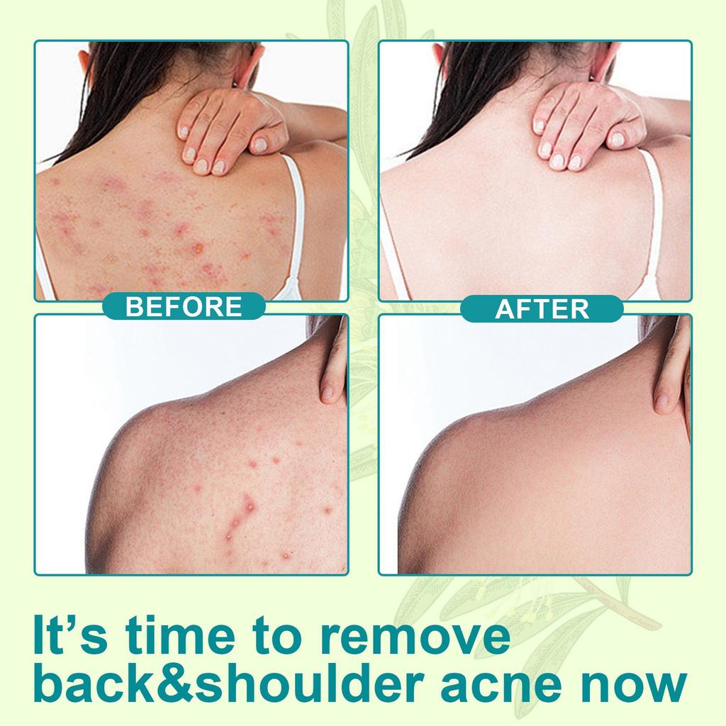 Back Acne Spray With Acne-removing Ingredients, Natural Back Acne Spray To Clear Back And Body Acne,120ML