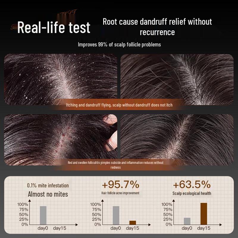 Baijiakang Coal Tar Medicated Shampoo for Dandruff & Seborrheic Dermatitis