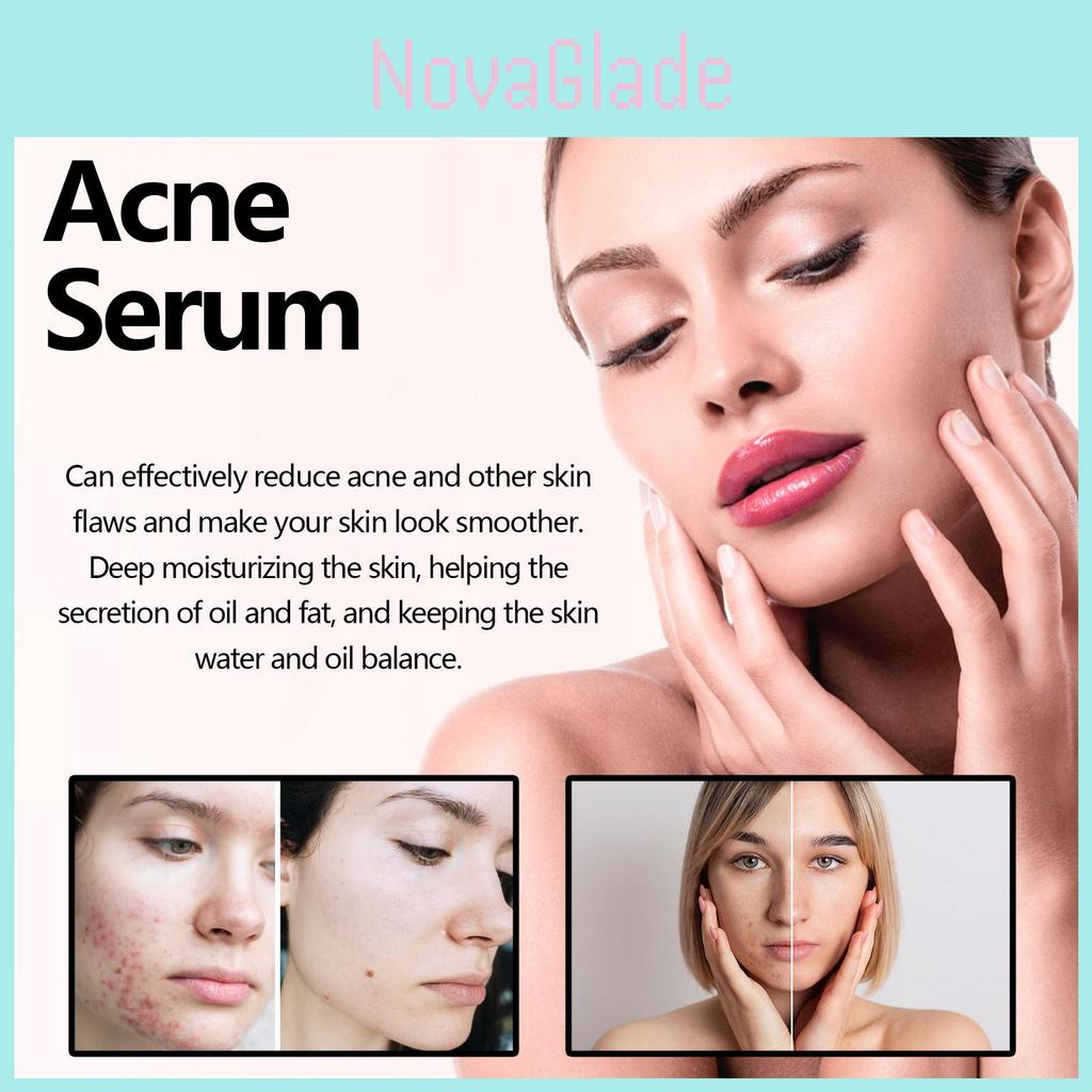 Eelhoe Green Tea Acne Serum Nourishing Antioxidant Formula For Brightening And Moisturizing