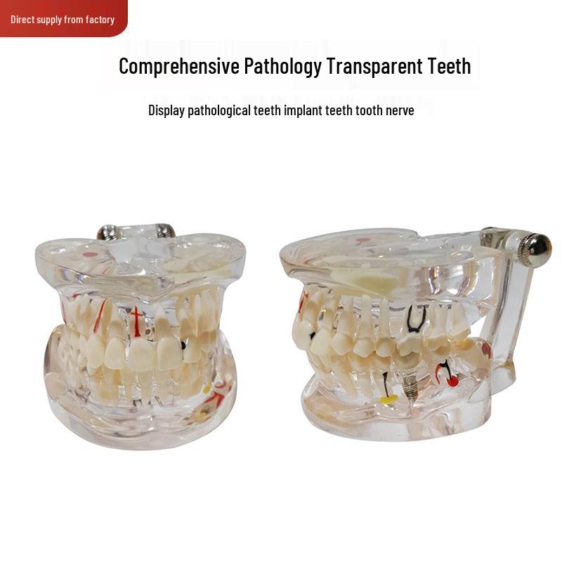 Transparent Dental Implant and Nerve Tooth Model for Comprehensive Pathology and Doctor-Patient Communication