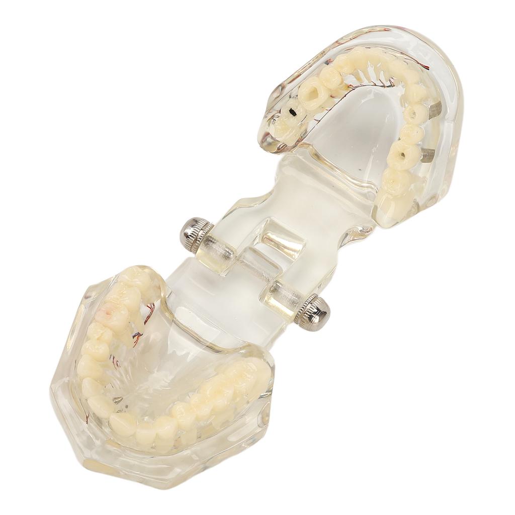 Transparent Dental Implant Pathological Model Implant Disease Teeth Model for Teaching Demonstration