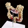 Human Colorectal Lesion Model Pathological Anatomy Colon Diseases Intestine Medical Teaching Learning Tool