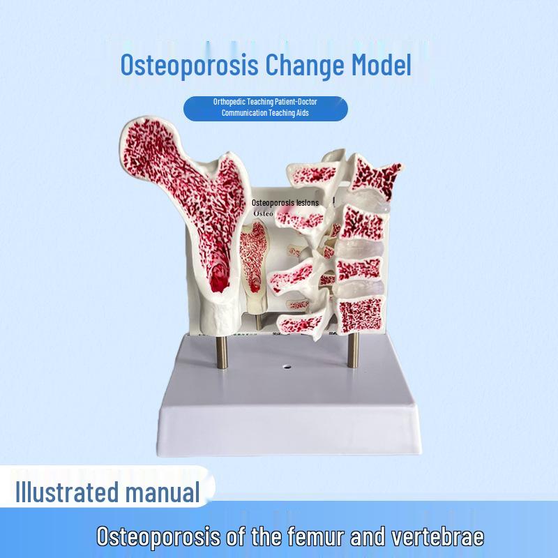 Osteoporosis Femur & Vertebrae Anatomical Model: Leg Bone, Spinal Column Cross-Section & Lumbar Pathology Specimen