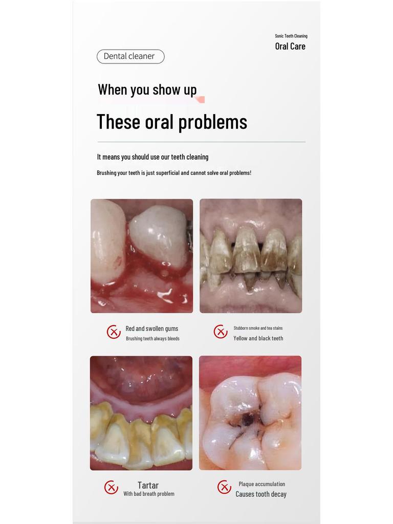 Nettoyeur de dents à ultrasons: Éliminateur de tartre, de taches et de plaque dentaire à trois vitesses pour le blanchiment des dents