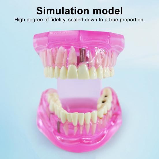 Dental Implant Model Teaching Aid for Dentist Student School Removable Teeth
