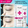 RtopR Acne Removal Cream Skin Repair Face Cream Acne Spots Acne Blackhead Whitening Cream