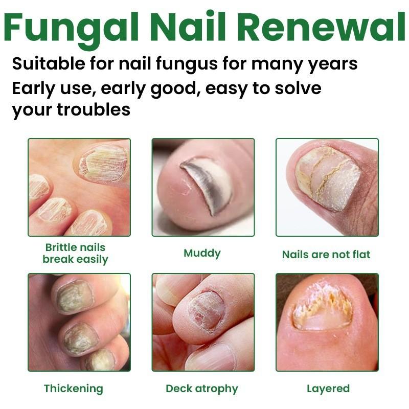 Eelhoe Nail Care Solution For Fungal Toenail Treatment With Nourishing Moisture