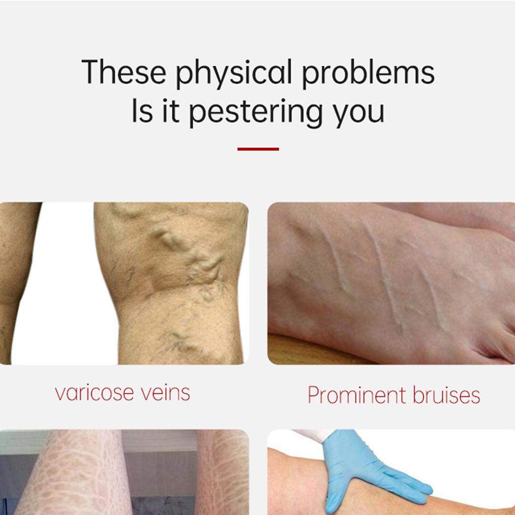 Varicose Vein Relief Paste Improve Blood Circulations Spider Varicose Vein  For Tired Heavy Legs Fast Relief New