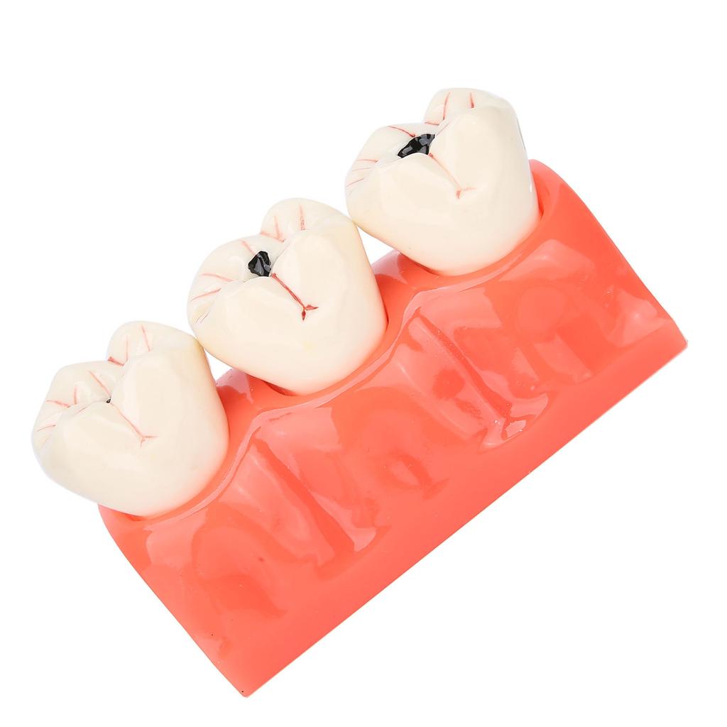 Dental Caries Model Tooth Decay Demonstration Model Simulation Detachable Teeth Model