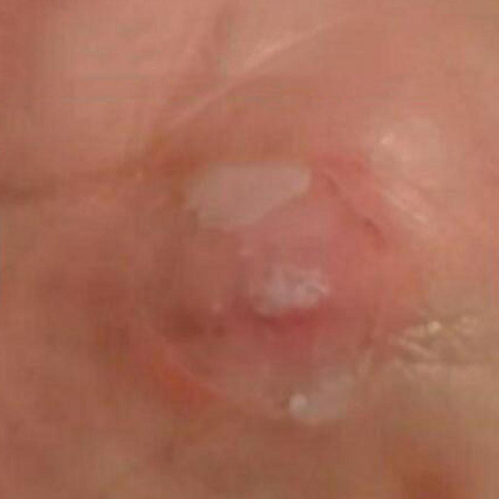 Foot Corn Remover Plaster Foot Pad Patches  Patch Pain Foot Care Tools