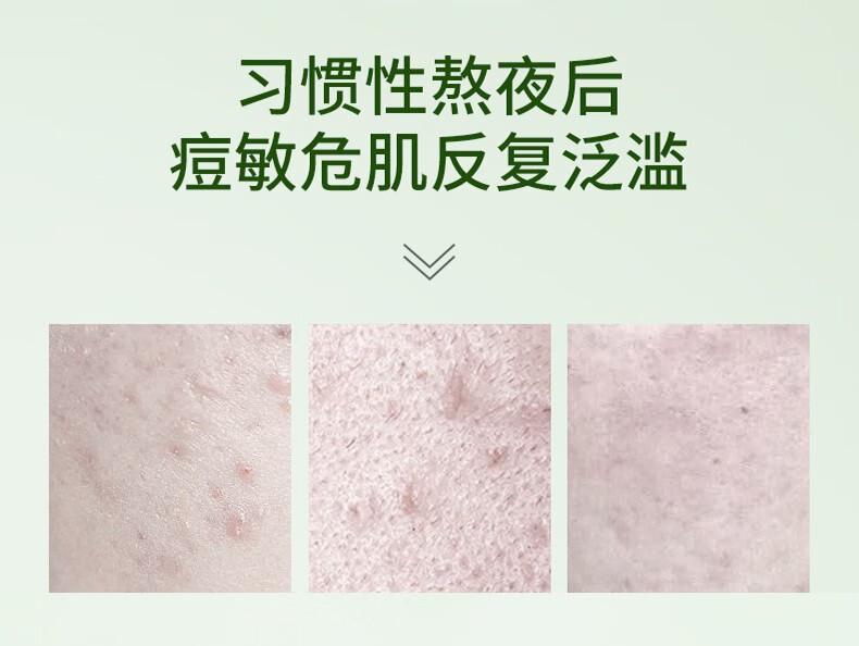 Beijing Tongrentang Herbal Acne Cream Acne Cream Acne Mark Scar Pit Repair Acne Skin Closed Acne 20g