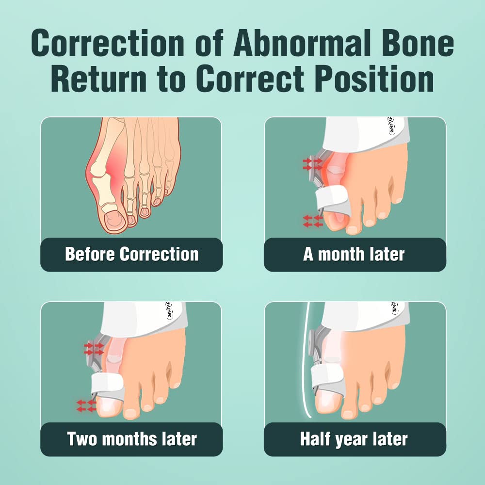Unisex Hallux Valgus Corrector, Orthopedic Hallux Valgus Corrector, Adjustable Hallux Valgus Splint with Silicone Inner Pad