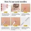 3-8pcs Acne Needle Remove Blackhead Comedone Extractor Tools Stainless Steel Facial Skin Care Tool Pimple Blemish Removal Tools