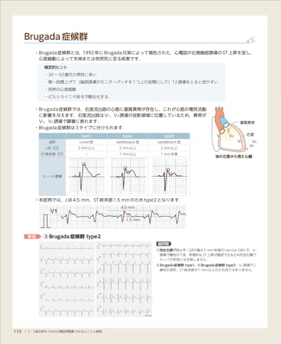 160 ECG Questions & Thorough Explanations To Pass Level 2 & 3 Exams - Get Stronger for the Actual Exam with Randomly Selected Practice Questions and P