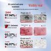 Yumei Chuangkeda Dual-Head Salicylic Acid Acne Treatment Essence