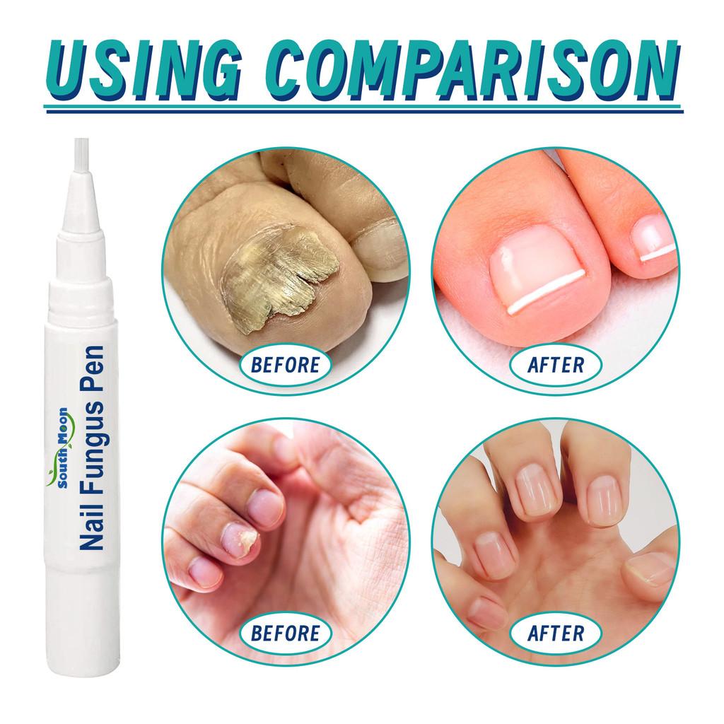 South Moon Nail Repair Pen Nourishing And Cleansing Solution For Thick And Brittle Nails