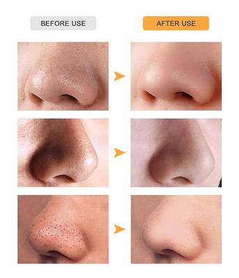 Ghelonadi Men and Women Deep Cleansing Pore Strips Nose Strips for Blackhead Removal and Pore Unclogging 10 PCS of Strips