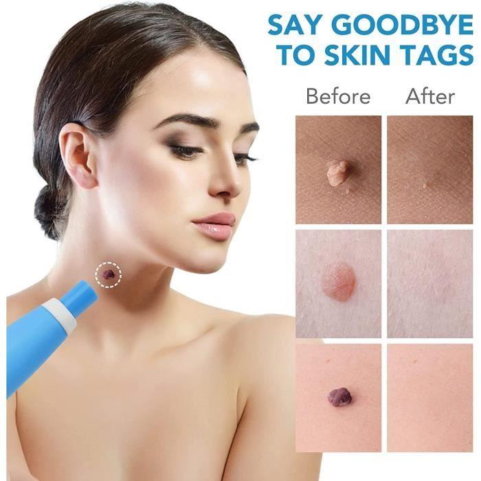 2 In 1 Skin Tags Treatment, Acrochordon Removal Kit Pen Delimitation For the Face, Neck, Finger and Body
