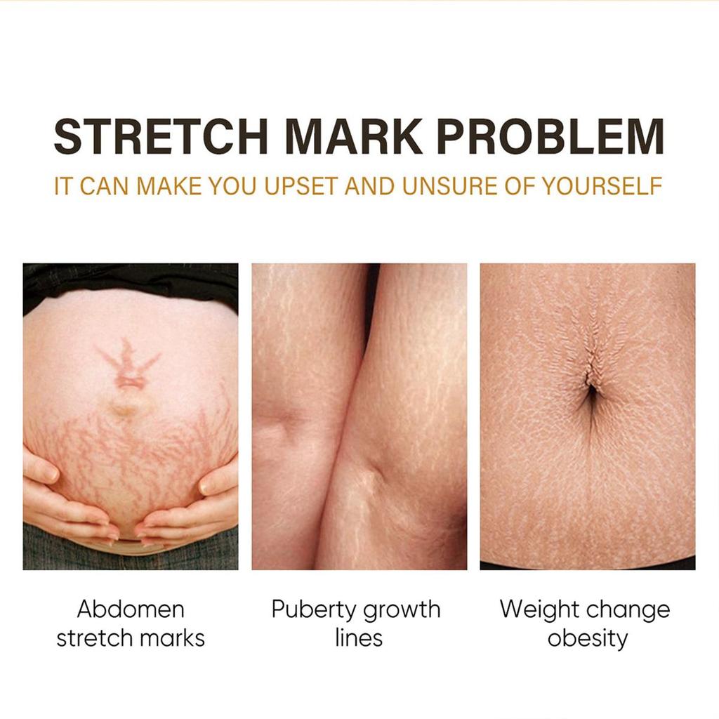 5G/15G/30G/50G/Pregnant Women's Belly Line Cream for Preventing Postpartum Pregnancy Lines Repair Cream