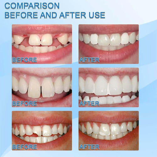 Tooth Repair Kit, Filling Repair Kit Dental, 30ml Dental Adhesive for Tooth Repair, Tooth Replacement Kit for Missing Teeth Broken Tooth Filler (3+1pc