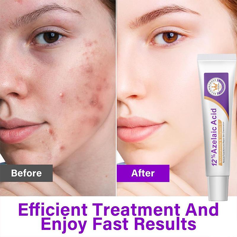 15% Azelaic Acid Serum for Fading Acne Scars and Marks