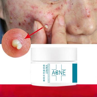 Acne Removing Cream Regulates Acne Muscles, Removes Acne, Desalinates Acne Marks, Moisturizes and Repairs Face Cream Acne Removing Cream
