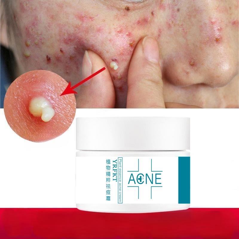 Acne Removing Cream Regulates Acne Muscles, Removes Acne, Desalinates Acne Marks, Moisturizes and Repairs Face Cream Acne Removing Cream