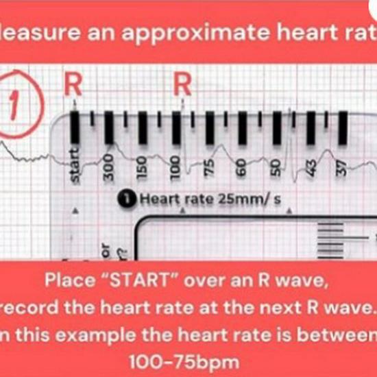 7-Step ECG Interpretation Ruler: Transparent Caliper Tool