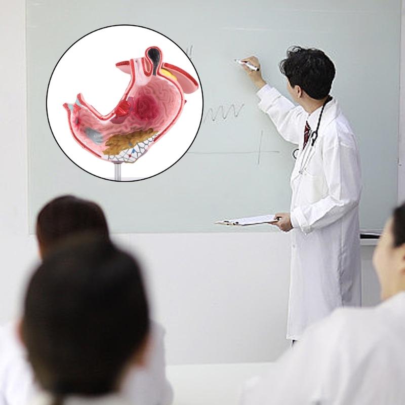 Diseased Stomach Model Stomach Anatomy Model Pathological Stomach Model For Medicals Students And Healthcare Learning