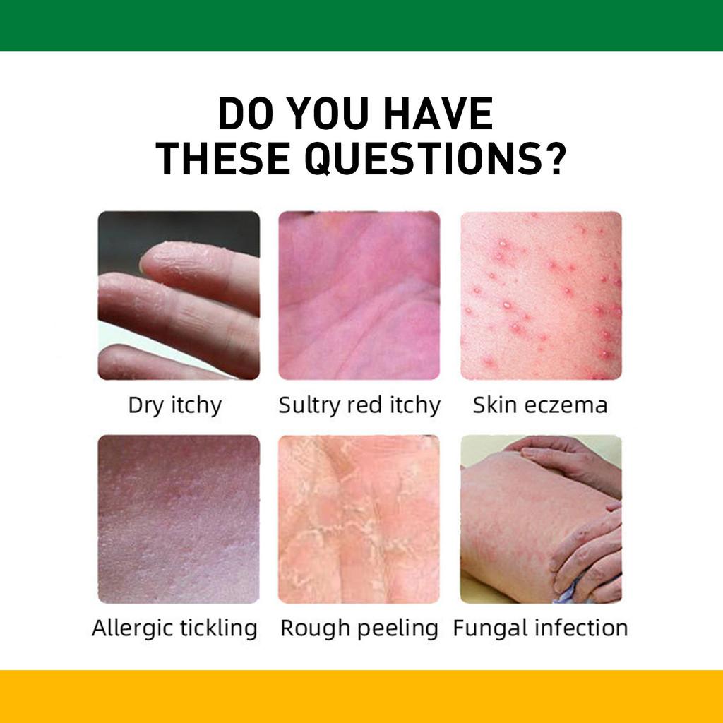 West Month Itch Relief Cream For Skin Soothing Effective For Mosquito Bites And Rashes
