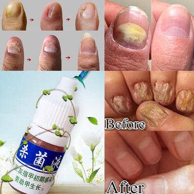 Trattamento antimicotico per unghie, onicomicosi, riparazione unghie, detergente liquido, siero disinfettante alle erbe