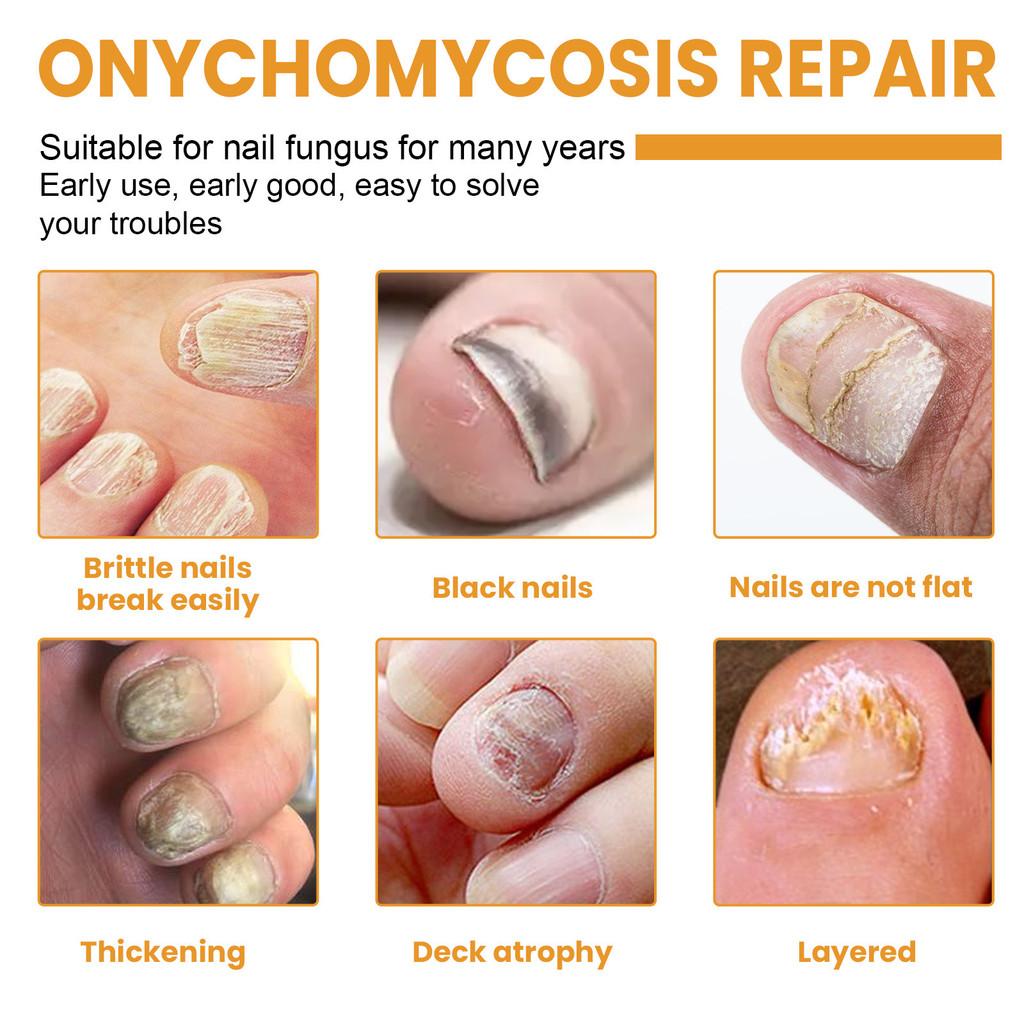 Ximonth Nail Repair Patch 32pcs Softening Thickening Treatment For Damaged Nails