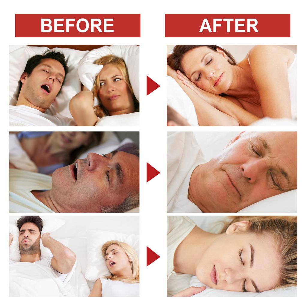 Ximonth Zachte Neuspleisters voor Comfortabele Verzorging en Verlichting van Neusklachten 75 stuks