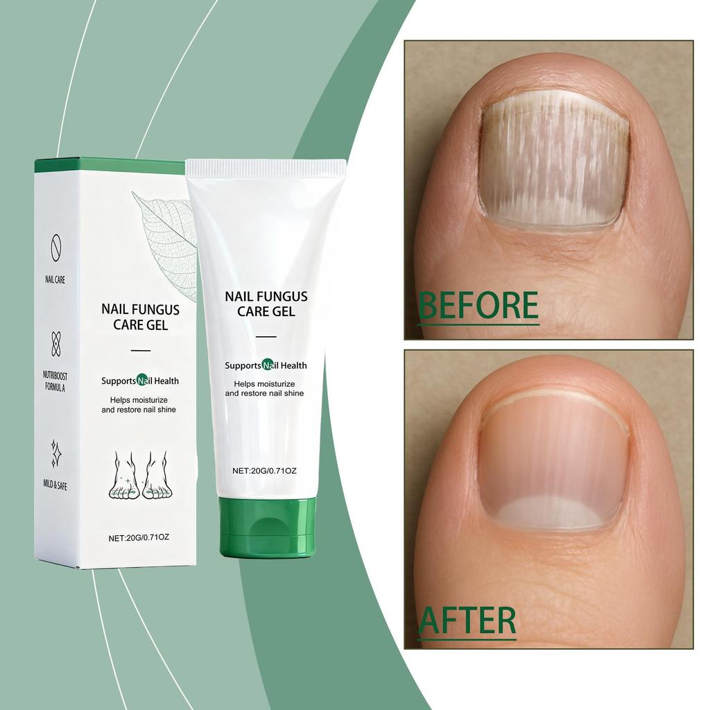 Nail Fungal Treatment Ointment Anti Infection Paronychia Onychomycosis Soft Hand Feet Toenail Repair Damaged Health Care Cream