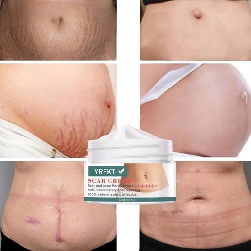 Cremă de întindere pentru cicatrici pentru acnee