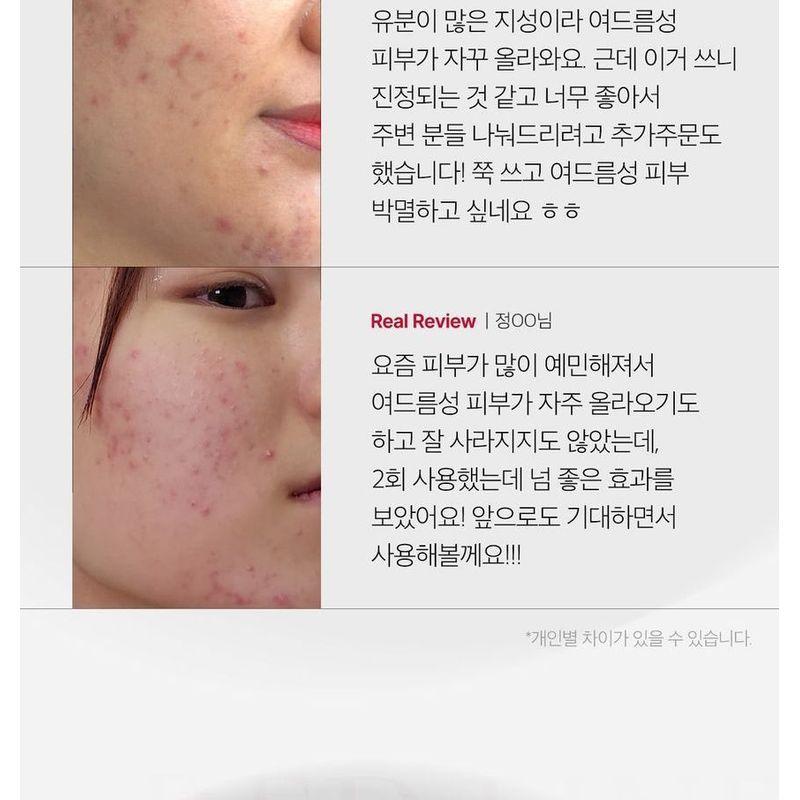 medicube - Red Acne Succinic Acid Peel