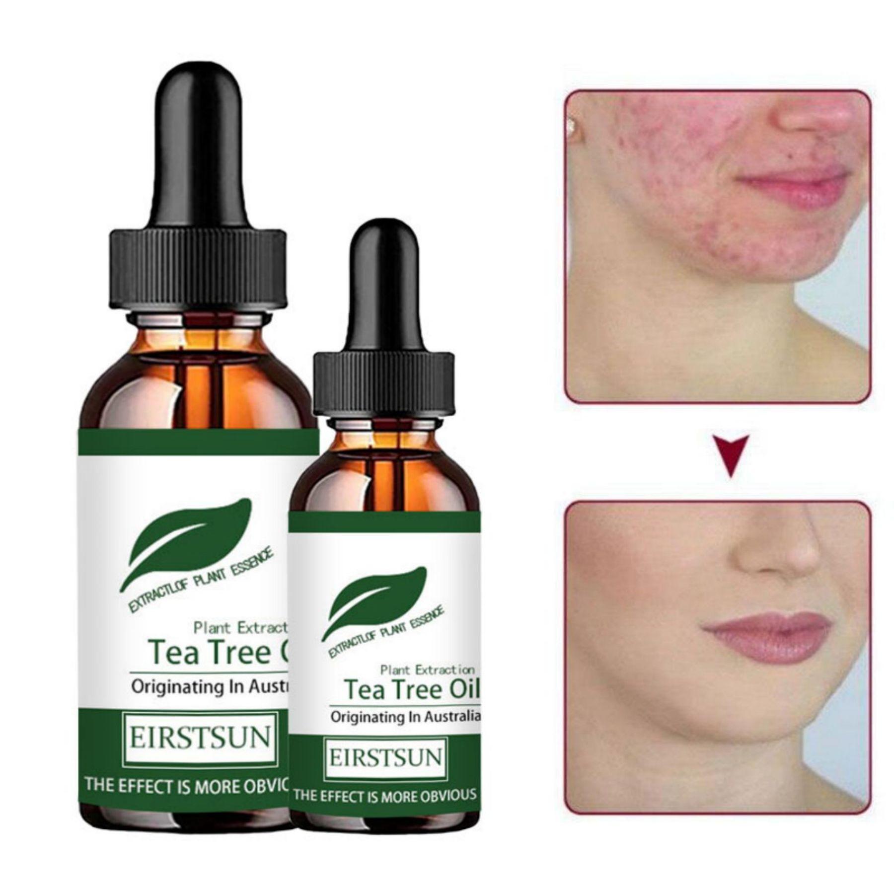 

Натуральное масло чайного дерева, увлажняющий крем для лица, тела, кожи для женщин, уход за волосами, аромат, ароматерапия, чистое массажное эфирное масло