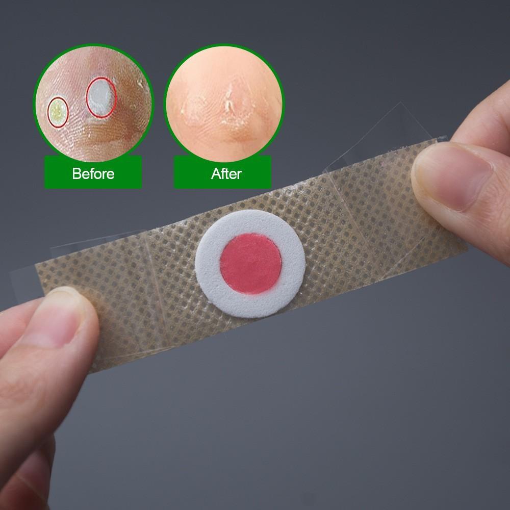Foot Corn Removal Killer Foot Protection Pain Relief Curative Plaster Medical Sticker Corns Plaster