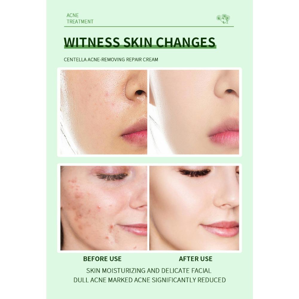 Centella Asiais Acne Cream