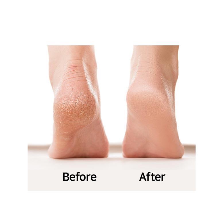 FOOTREE Foot Peeling Mist 150ml