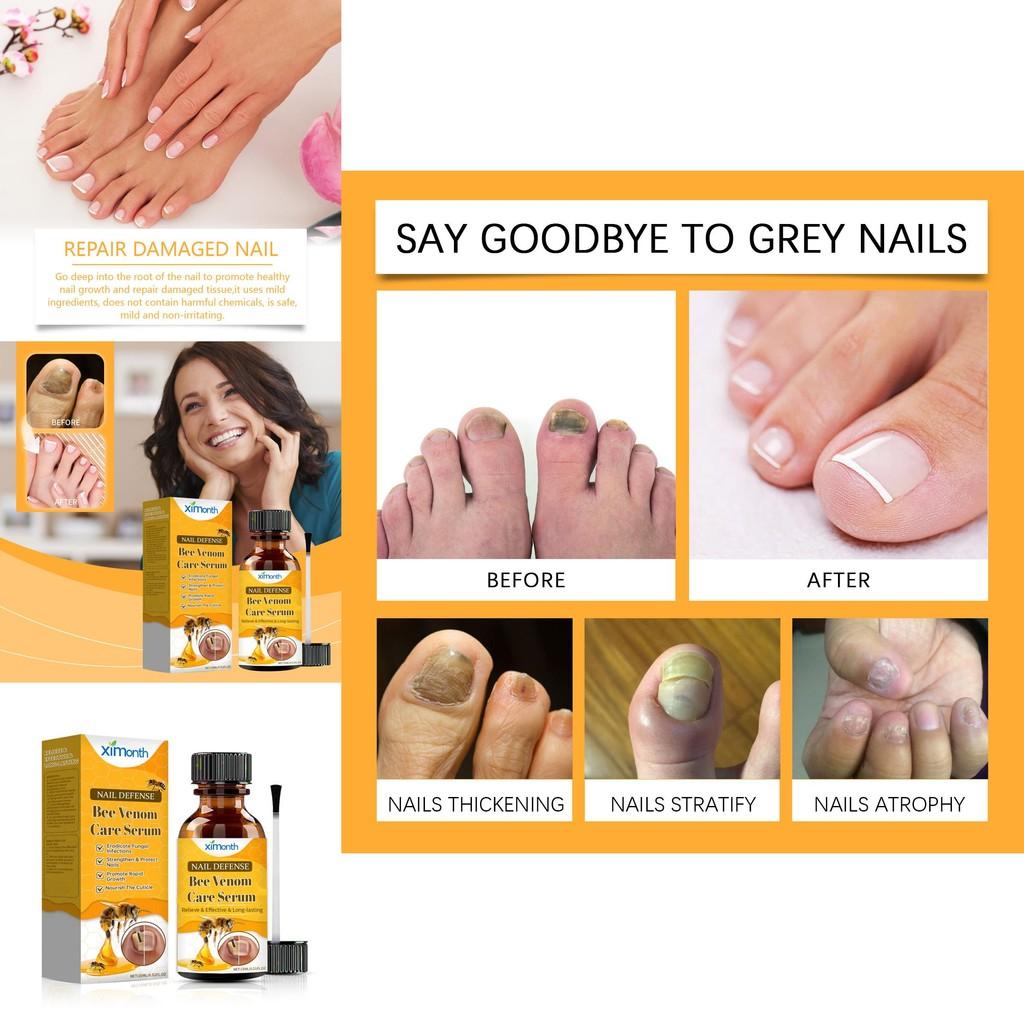 Ximonth Bee Venom Nail Care Liquid For Fungal Infection Treatment And Nail Brightening With Nourishing Formula For Healthy Feet And Hands