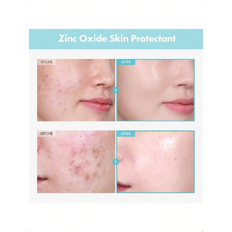 Tosowoong SOS Repair CICA Clinic Zinc Cream 50g | Ultra-High 100,000ppm Zinc Oxide Formula, Heals & Soothes Acne, Redness & Rosacea