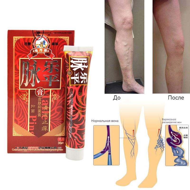 Natural Extract Varicose Vein Relief Vasculitis Phlebitis Spider and Improved Circulation