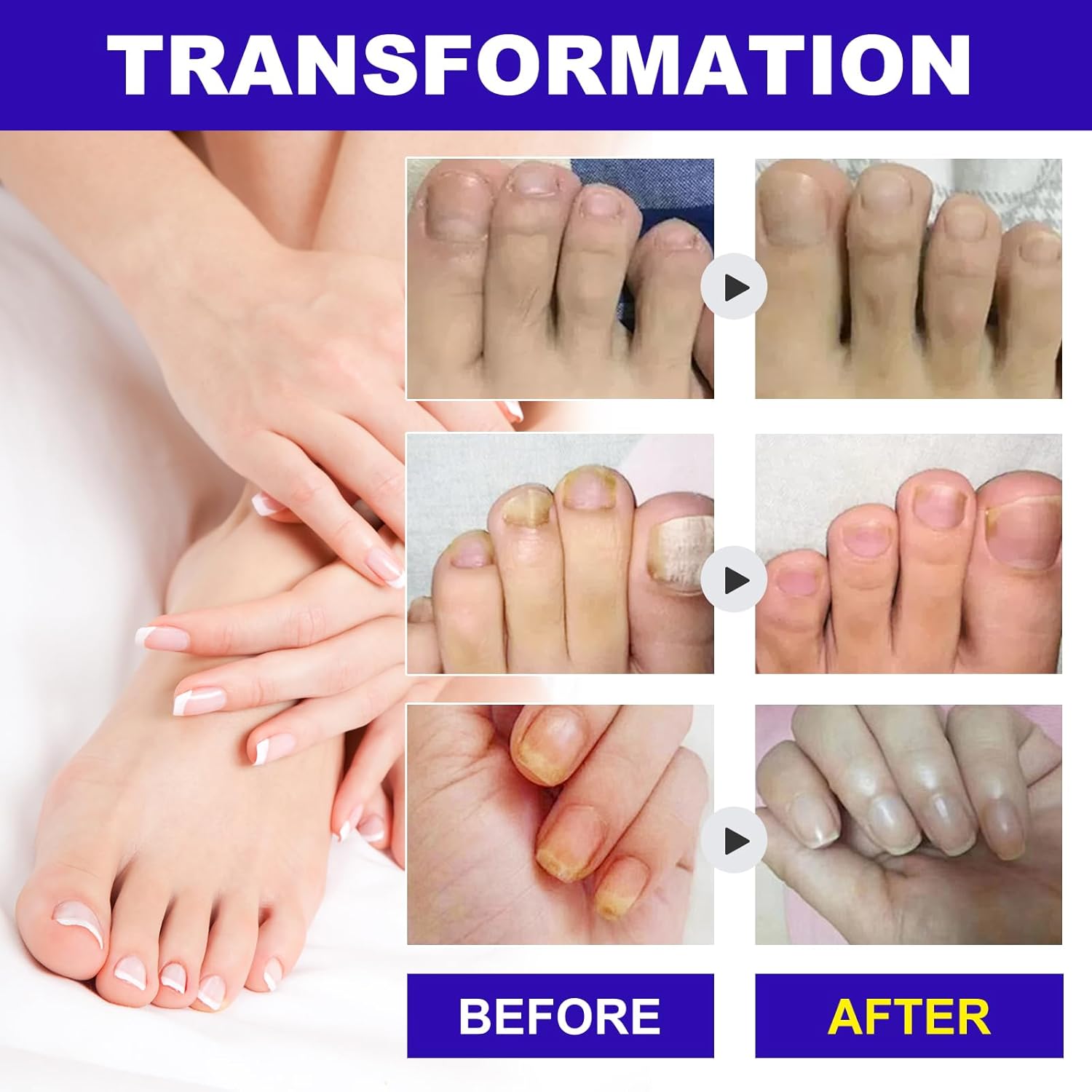 Nail Treatment Patches Extra Strength - Nighttime NailPatches,Discolored &Thickened Nails Repair, Treatments for Damaged Nails, 24 Pcs